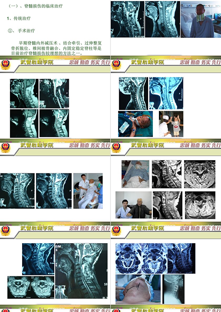 2023年脊髓損傷研究新進(jìn)展，里程碑式的突破與日常奇妙變化