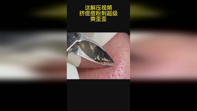 最新擠膿包視頻，見證變化的力量，自信與成就感的誕生之地