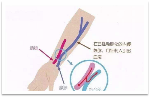 靜脈瘺最新資訊，掌握最前沿的健康信息